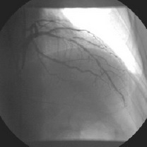 Stenoza de
bifurcaţie, stent implantat în vasul principal