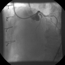 Bolnavă cu angină instabilă, prin stenoza strânsă IVA (interventriculara anterioara) proximal; distal de diagonala majoră, se reumple interventriculara prin LIMA (artera mamara interna stinga) patentă