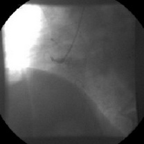 Infarct miocardic acut inferior, prin ocluzia coronarei drepte