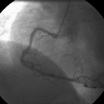 Aspect angiografic după plasarea a 5 stenturi pentru acoperirea disecţiei până în aortă