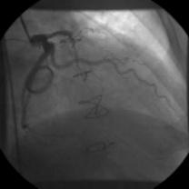 Ocluzie IVA proximal