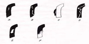 Tipuri de disecţie: schema reprezintă coronara dreaptă la unirea segmentului 2 cu 3, zona predispusă la disecţie(în negru apare substanţa de contrast)