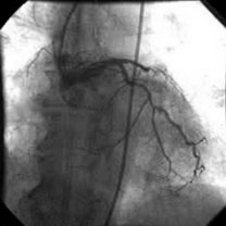 Infarct miocardic acut anterior la 1 oră de la debut, la 5 zile de la stentare pentru infarct acut în acelaşi teritoriu; ocluzie de IVA. Pe interventriculară, proximal, apare o placă ulcerată, fără a realiza stenoză semnificativă