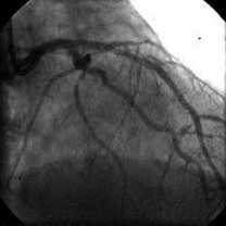 Stentare directă, distal de stent şi supraexpandarea primului stent, urmată de stentarea leziunii ulcerate.