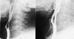 Stenoză de arteră carotidă internă stângă