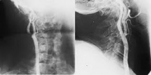 Stenoza de arteră carotidă internă dreaptă