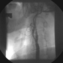 Stent pe artera carotidă dreaptă, restenoză în stent pe carotida stângă