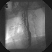 Aspect angiografic după implantare de stent în stent (stent auto expandabil Wallstent)