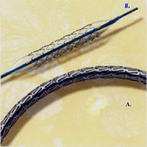 Stent balon expandabil