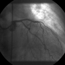 Implantare de stent distal de primul stent cu suprapunerea lor parţială şi expandarea la 14 atm. a ambelor stenturi